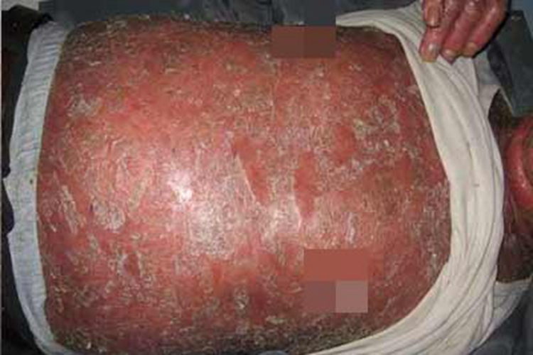 红皮病型银屑病肚子发红脱皮图 红皮病型银屑病肚子发红脱皮图