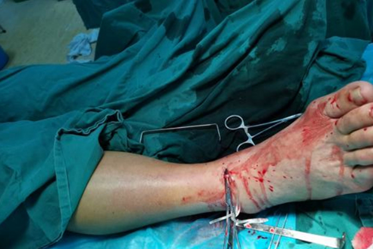 脚背动脉破裂出血图