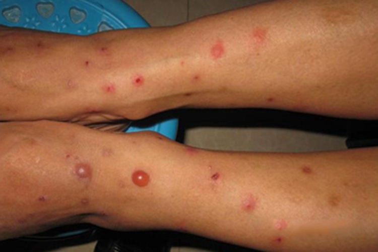 急性单纯性痒疹小腿症状图 急性单纯性痒疹小腿症状图