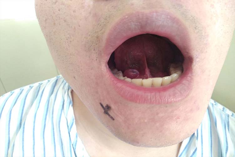 单纯型舌下腺囊肿图