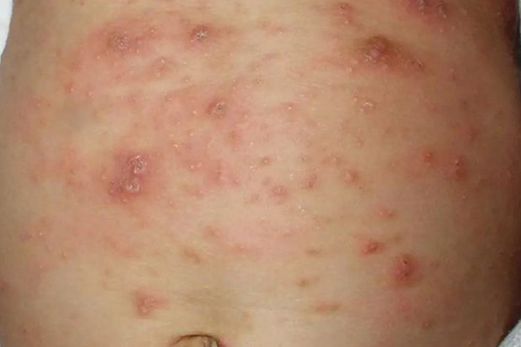 体癣合并湿疹样改变图片