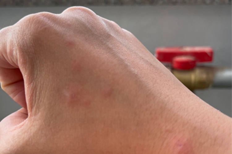 痒疹手背疙瘩图