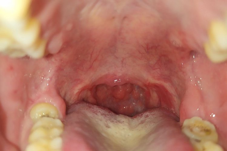 术后完全恢复图 术后完全恢复图