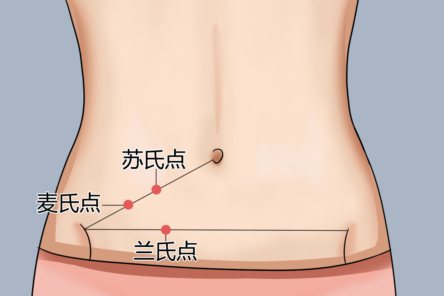 阑尾炎压痛点位置图