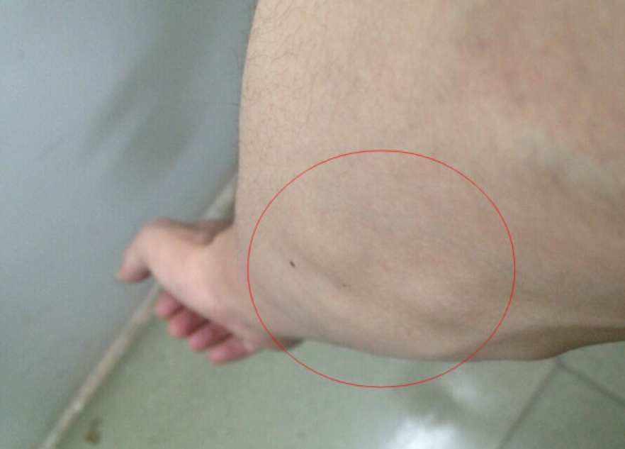 手臂筋膜炎皮下结节图