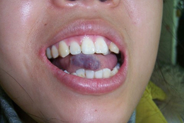 海绵状血管瘤舌头肿块图