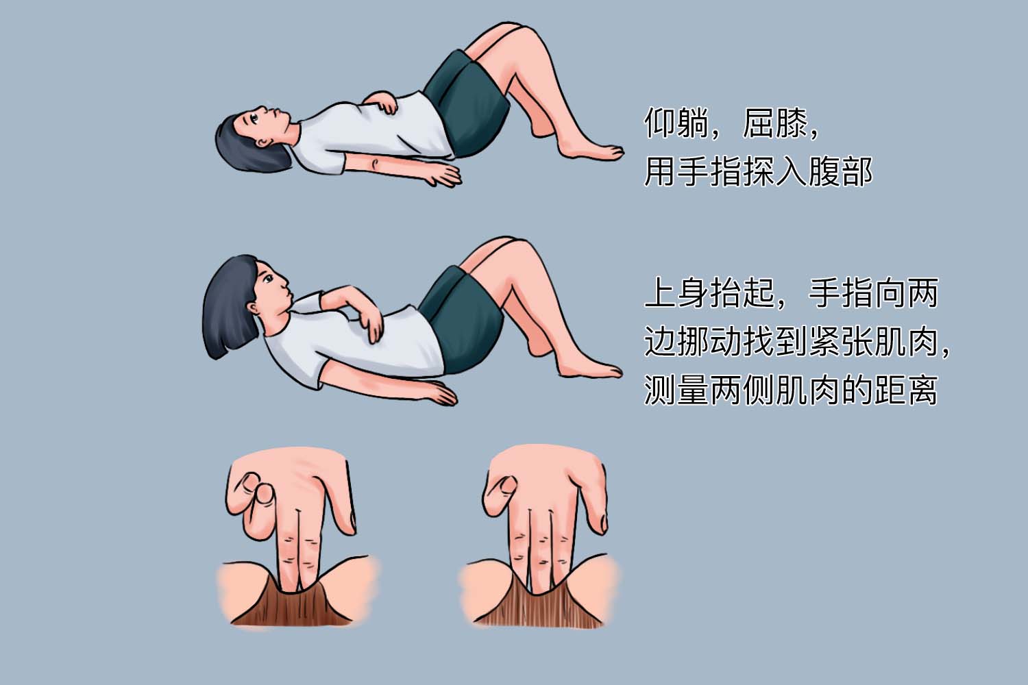 腹直肌分离自测图