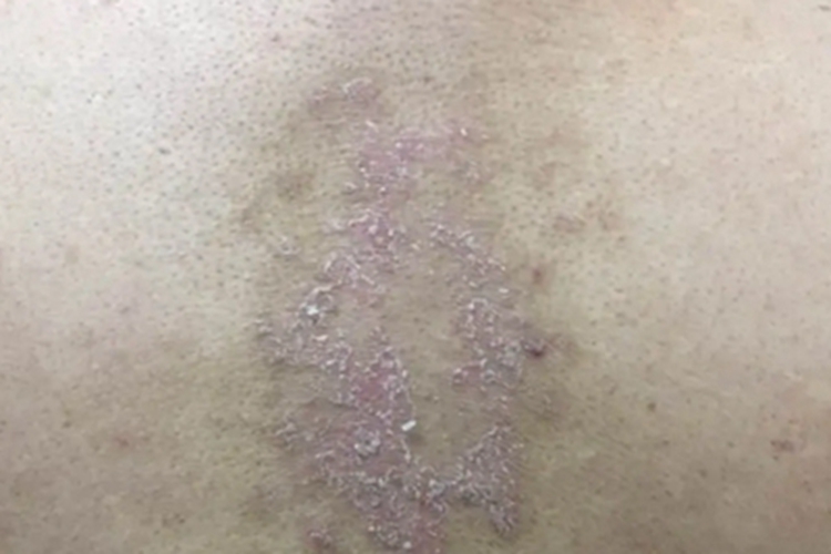 慢性湿疹背部脱皮图 慢性湿疹背部脱皮图