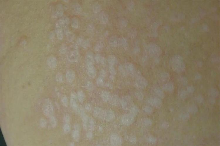 初期硬化萎缩性苔藓图