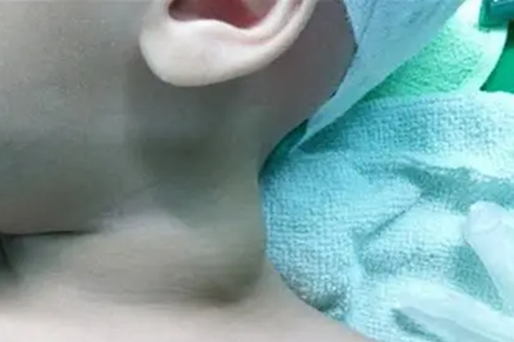 囊性淋巴管瘤图