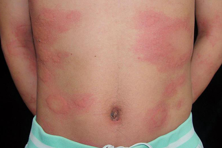 慢性自发性荨麻疹风团图