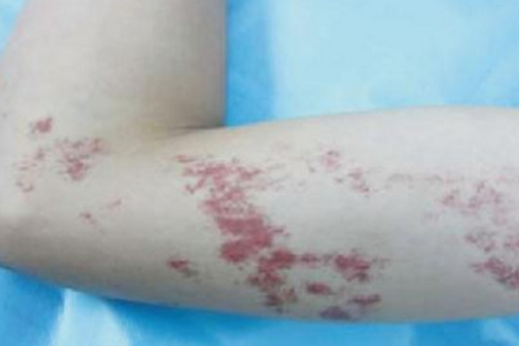 匍行性血管瘤胳膊上有红斑图