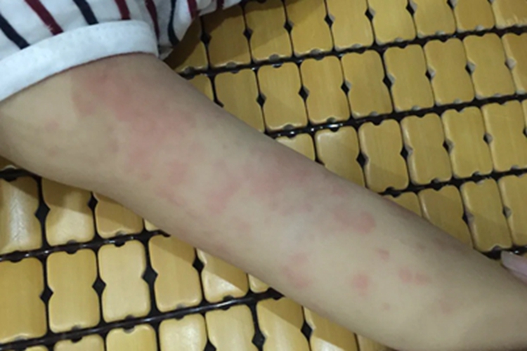 小螺菌型鼠咬热红斑图