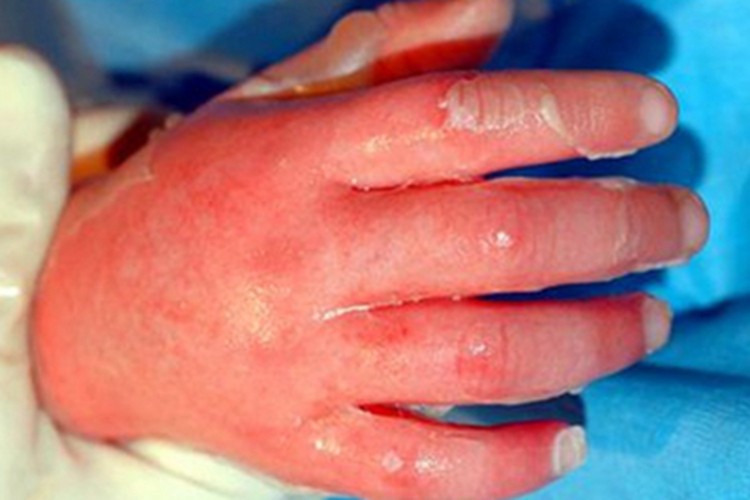 脓疱疮水疱图 脓疱疮水疱图