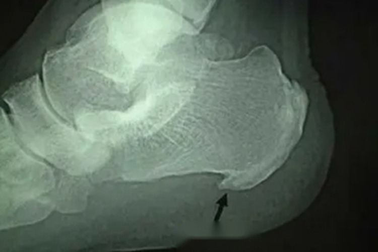 脚底长骨刺影像图 脚底长骨刺影像图