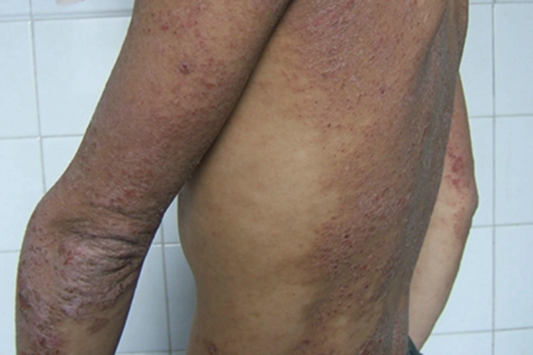 青年成人期特应性皮炎身上结痂图 青年成人期特应性皮炎身上结痂图