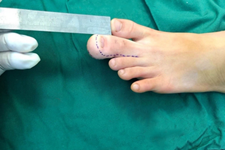 巨指畸形左脚脚趾肥大图