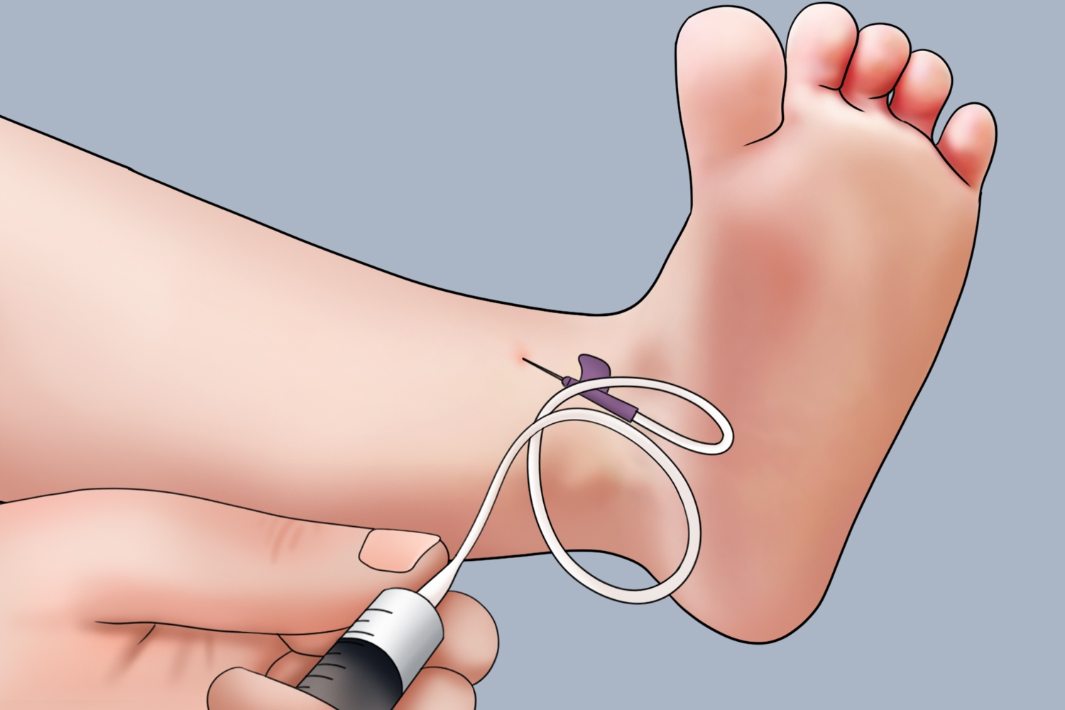 宝宝踝部采血图