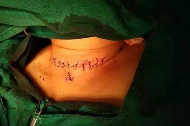 甲状腺手术缝合图