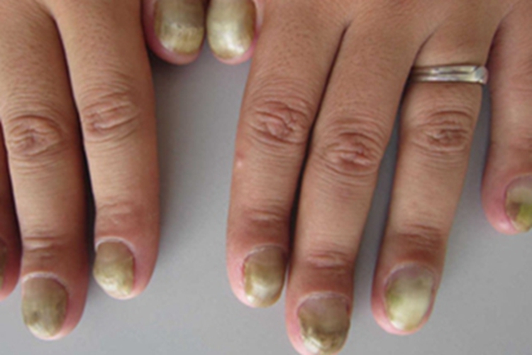 黄甲综合征症状图