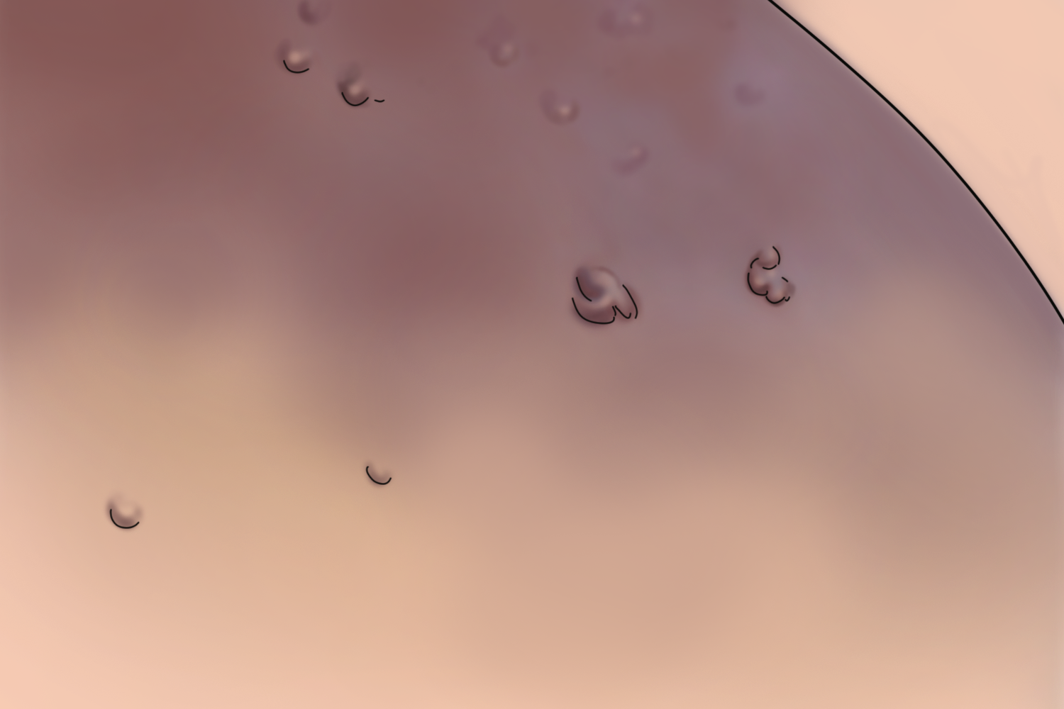 蒙氏结节真人高清图