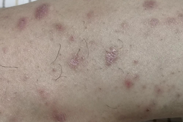 毛发扁平苔藓小腿小红疙瘩图