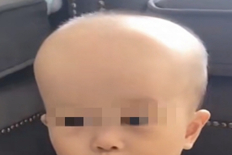 软骨发育不良前额变形图