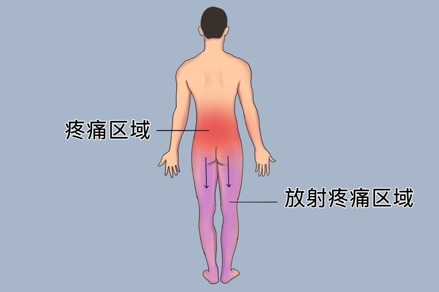 腰椎间盘突出症腰上面疼痛图