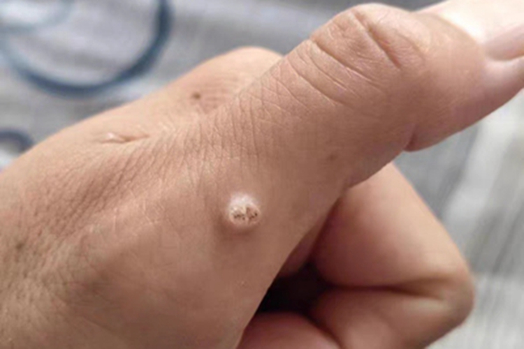 寻常疣手部硬包图