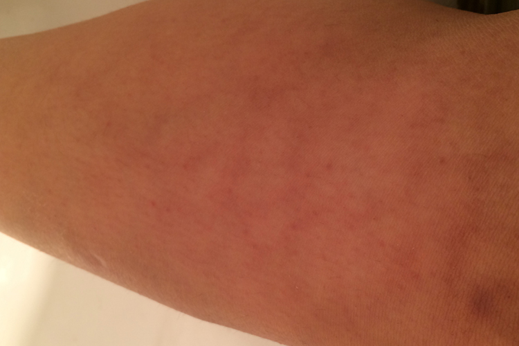 火激红斑初期图