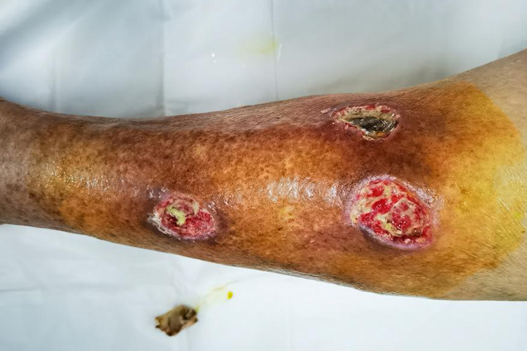 腿部坏疽性脓皮病图