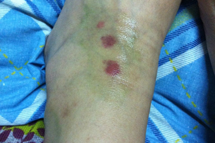 血吸虫尾蚴皮炎脚踝症状图