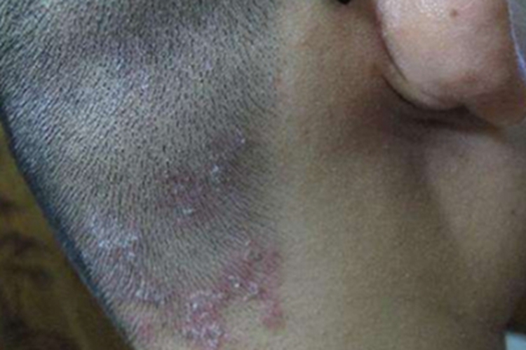 斑状淀粉样变后颈症状图 斑状淀粉样变后颈症状图