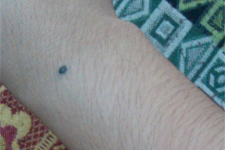 蓝痣胳膊症状图