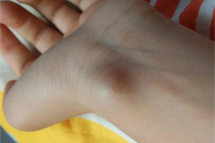 手腕腱鞘囊肿手腕症状图