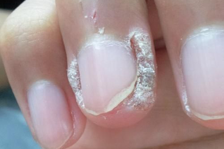 手癣指甲两边长硬角质图