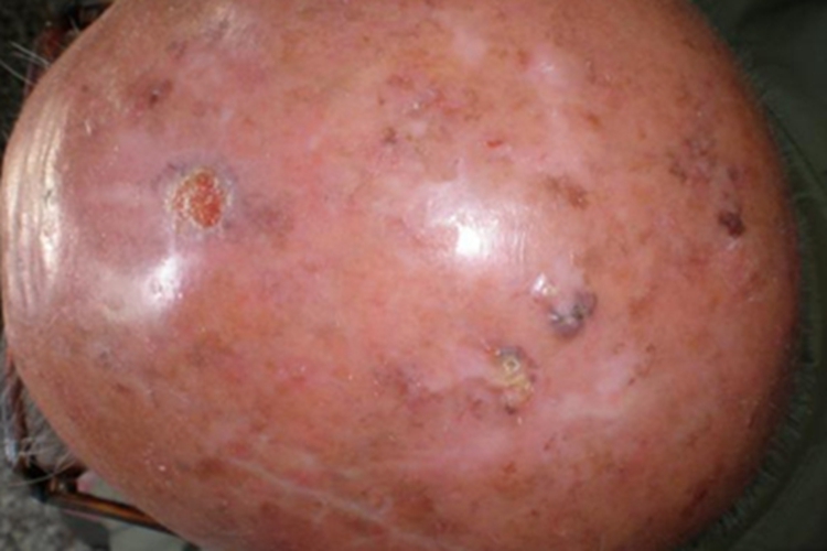 光线性角化病头皮症状图