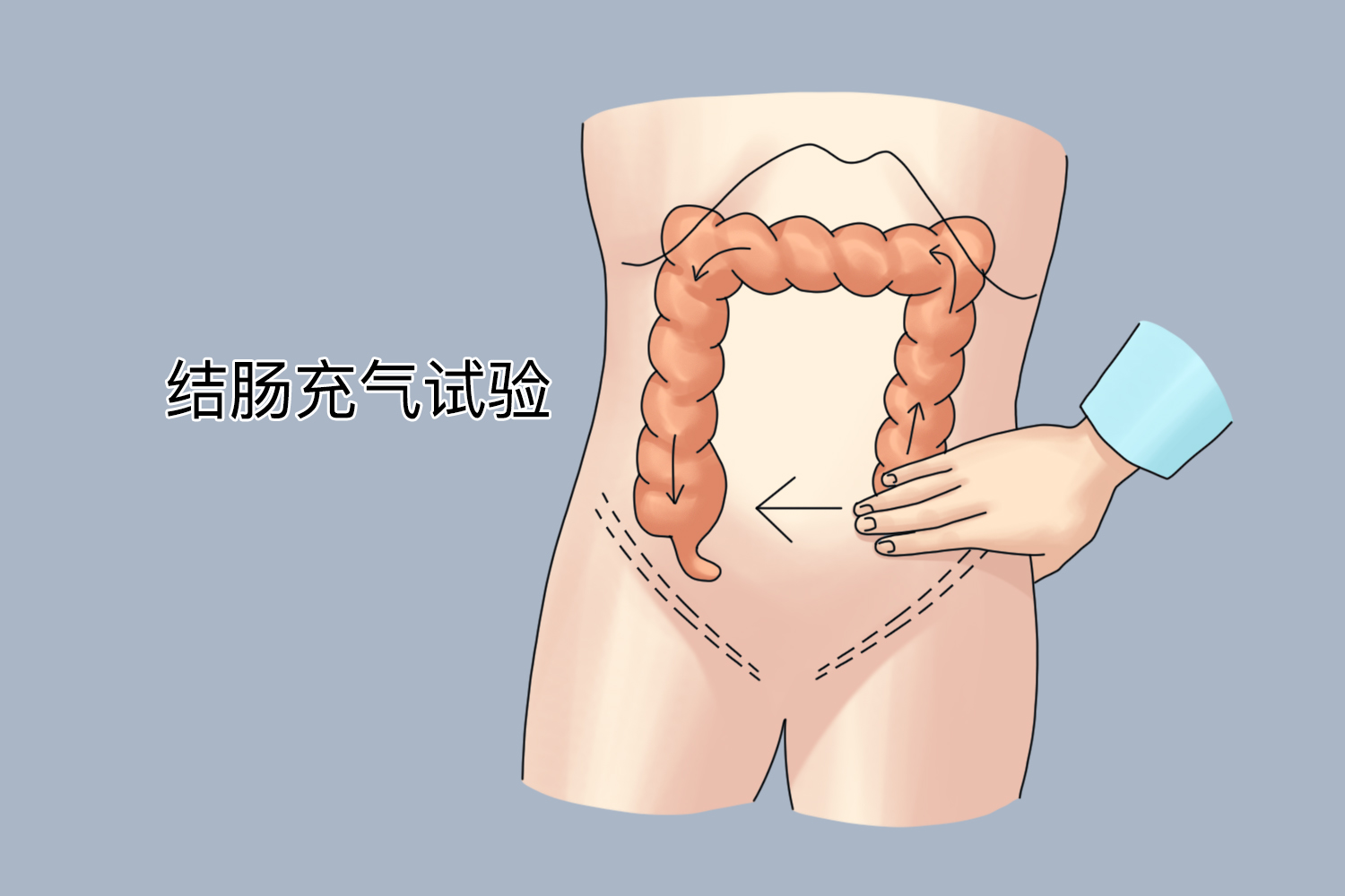结肠充气试验图 结肠充气试验图