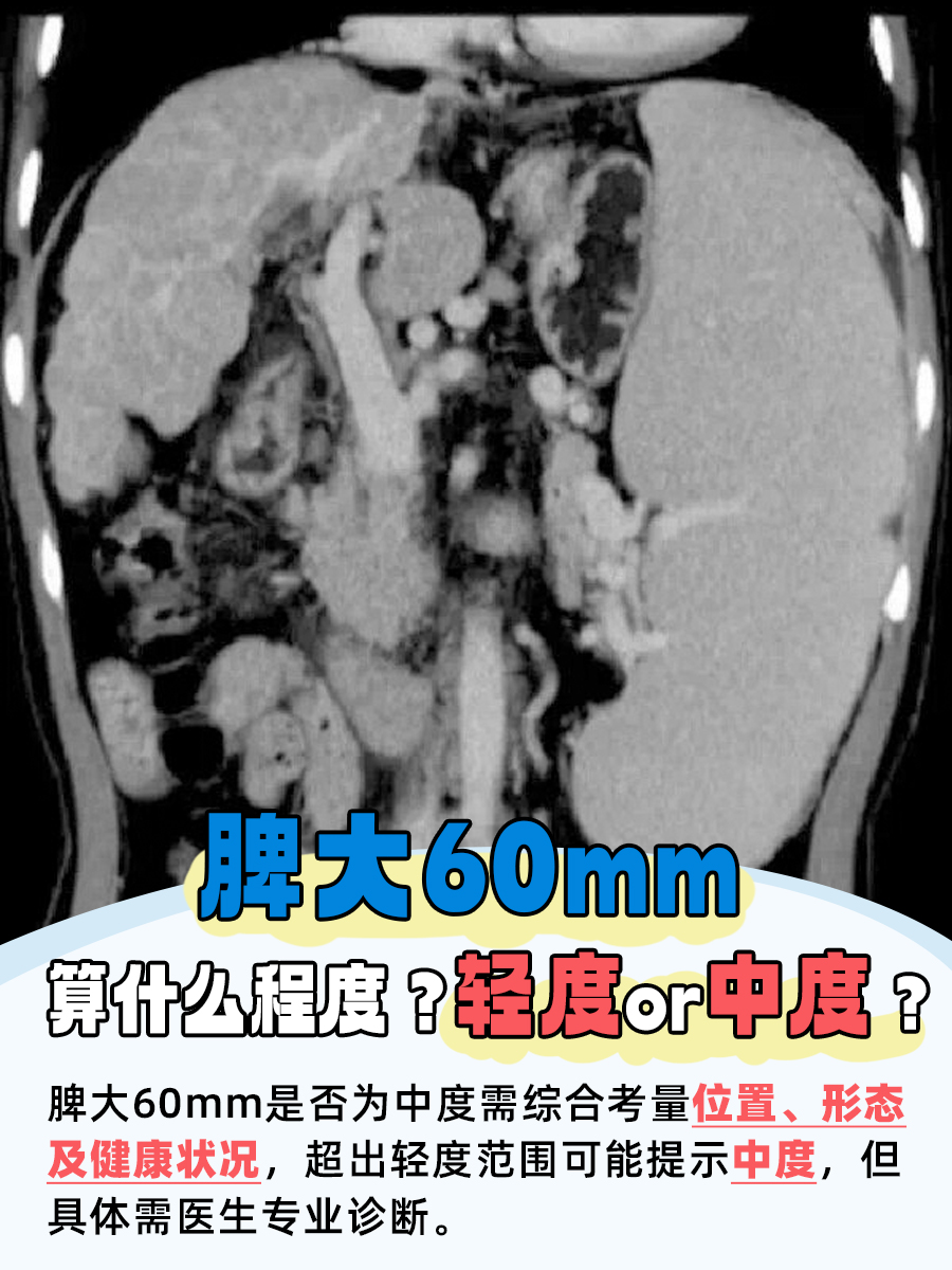 脾大60mm算什么程度？轻度or中度？