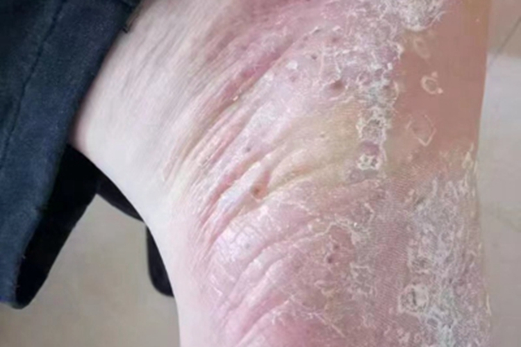 水疱型足癣脚底脱皮图