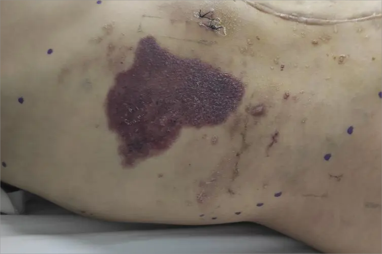 蔓状血管瘤右腹红斑图