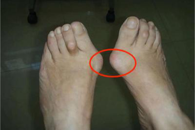 拇趾滑囊炎症状图