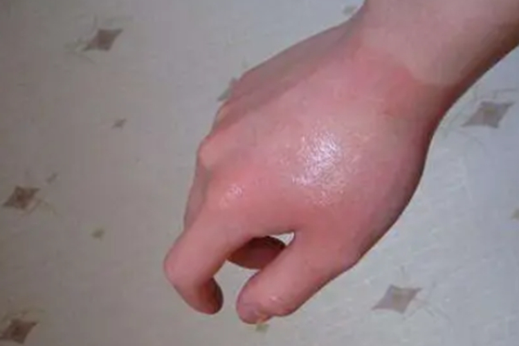 烫伤手部红斑图