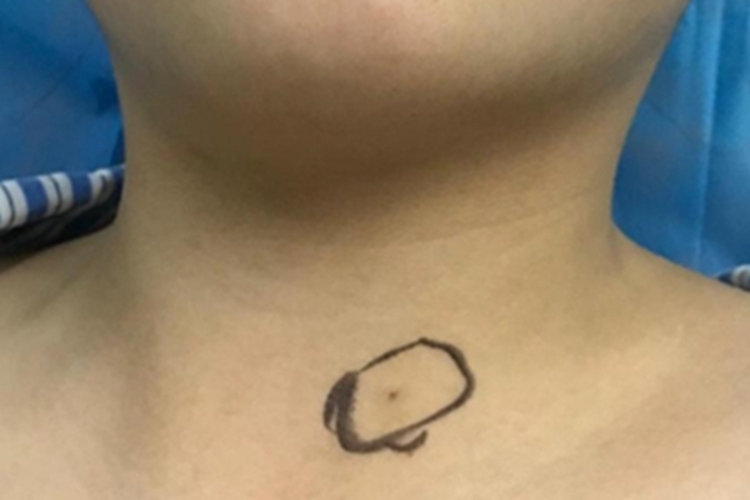 第二鳃裂瘘管颈部小孔图