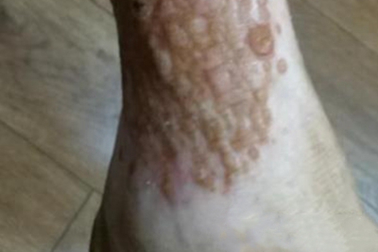 泛发型表皮痣小疙瘩图 泛发型表皮痣小疙瘩图