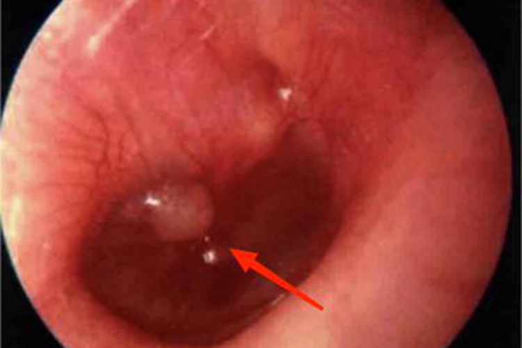 鼓膜炎外耳道里面有包图 鼓膜炎外耳道里面有包图