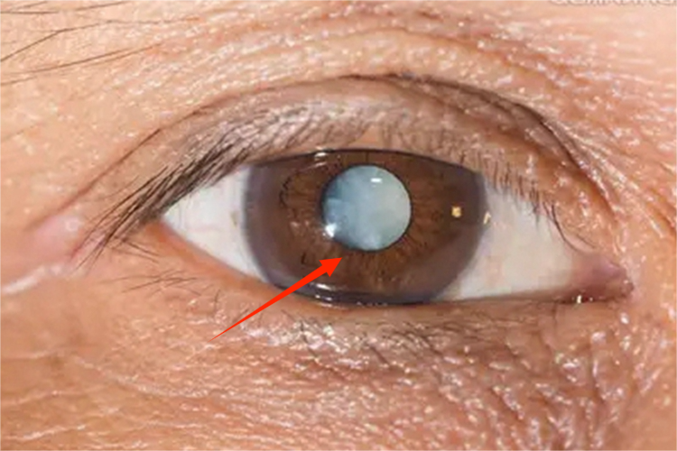 先天性皮肤异色病眼部症状图 先天性皮肤异色病眼部症状图
