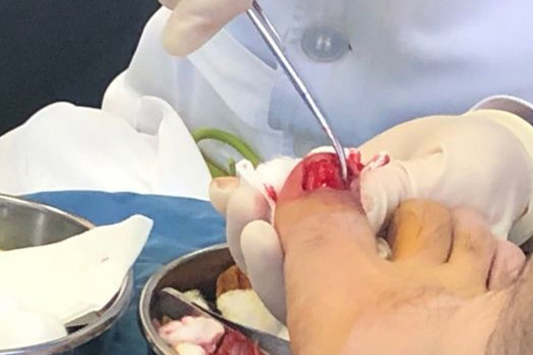 拔甲术后图 拔甲术后图