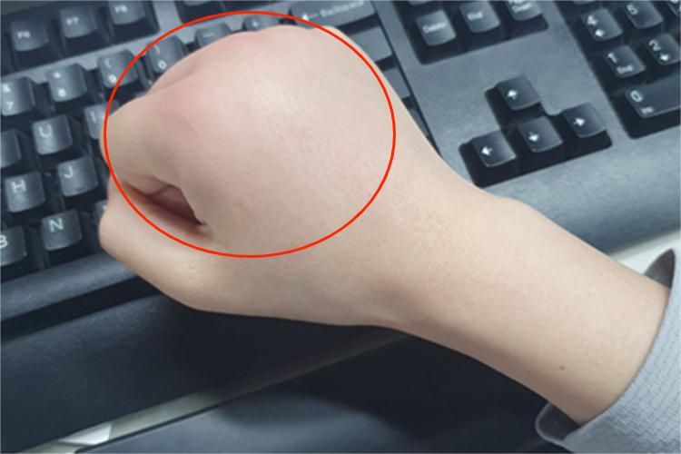 急性自发性荨麻疹水肿图 急性自发性荨麻疹水肿图