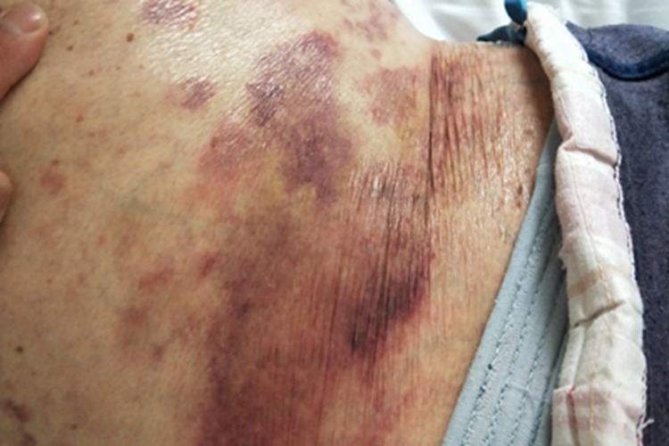 血管内压力增多性紫癜腹部斑图